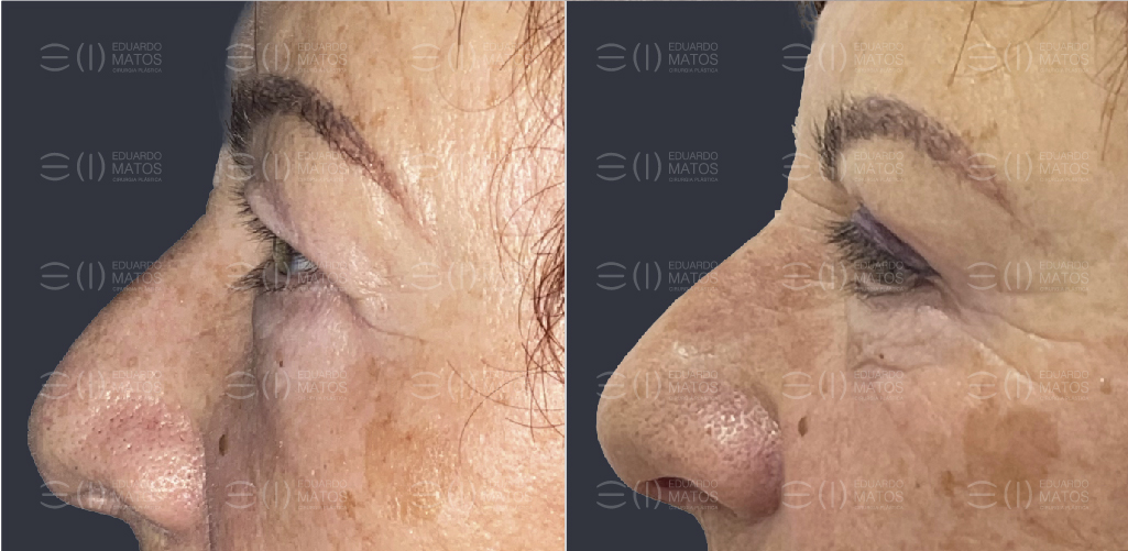 Blefaroplastia