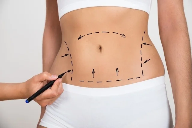 lipoabdominoplastia,abdominoplastia, lipo, lipoaspiração, cirurgia plastica